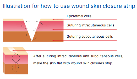 Illustration for how to use wound skin closure strip